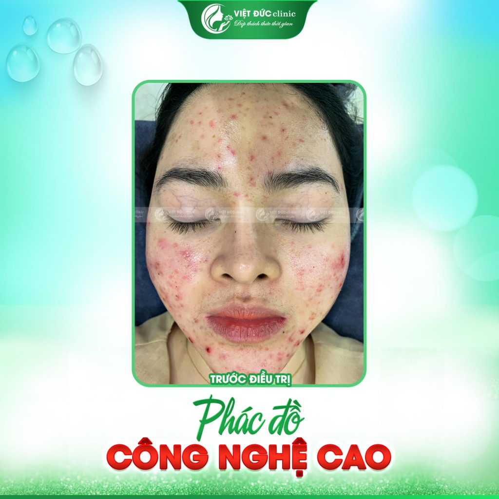 Trước khi trị mụn thành công làn da tôi vô cùng nhiều mụn, viêm đỏ