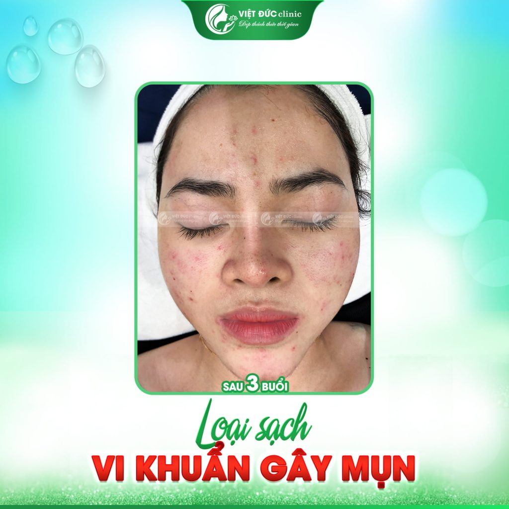 Quá trình trị mụn thành công đã gần chạm tay tới
