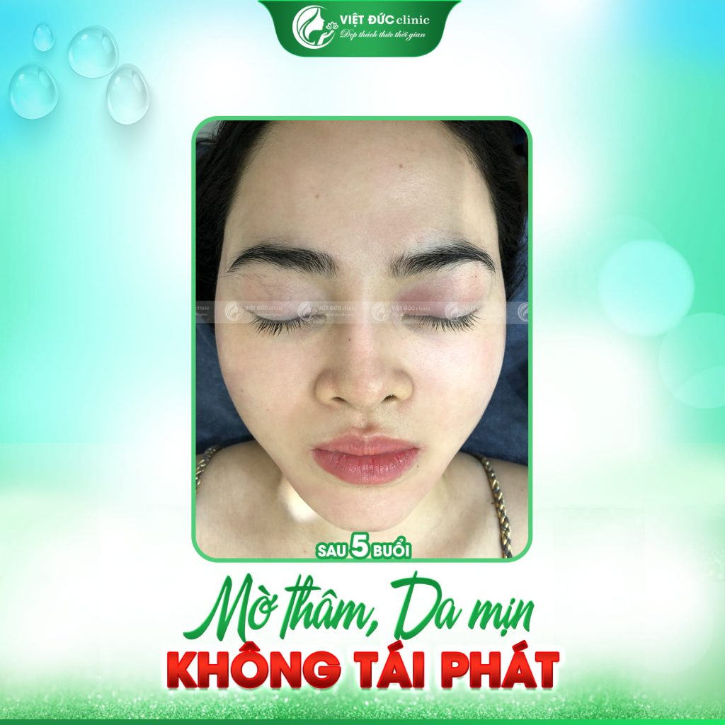 Sau 1.5 tháng hành trình trị mụn thành công của tôi đã thành sự thật