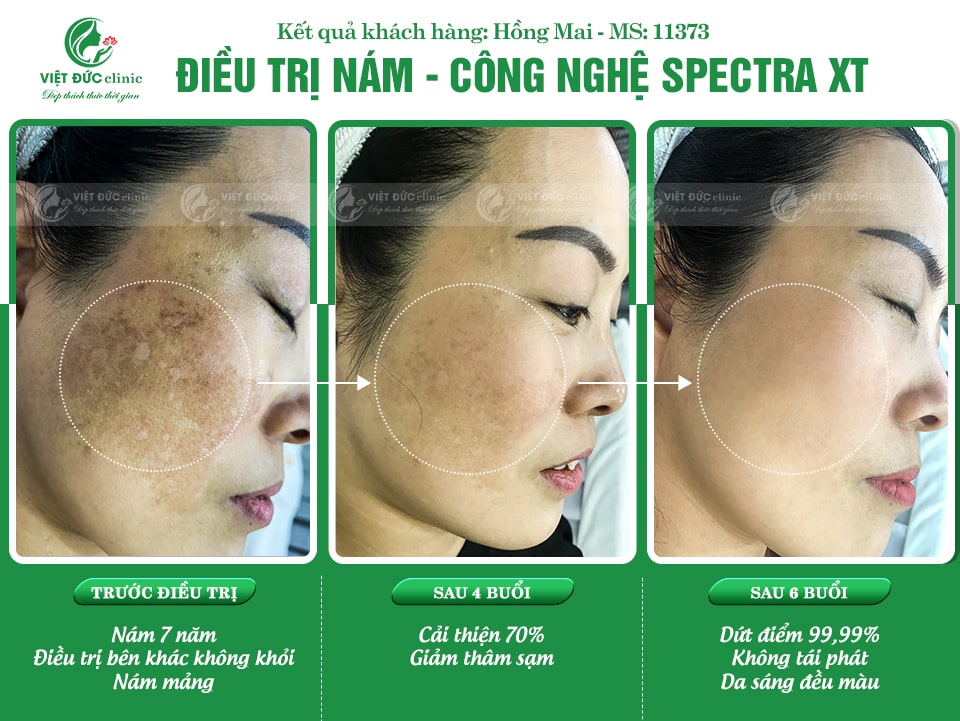 Hiệu quả rõ rệt sau khi thực hiện trị nám chuyên sâu tại Việt Đức Clinic
