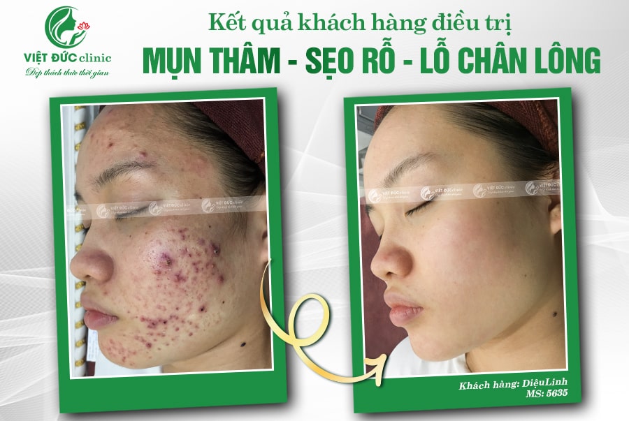 Hành trình hồi sinh làn da sẹo chỉ sau 5 buổi