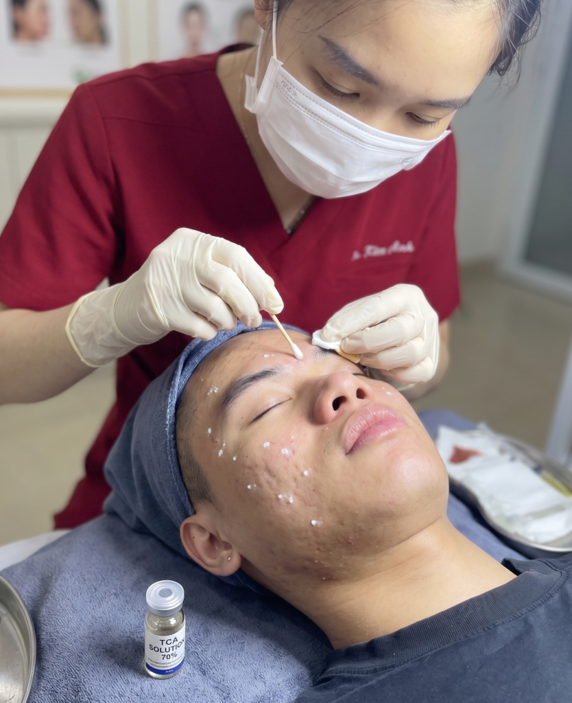 Bác sĩ đang thực hiện trị sẹo rỗ TCA cho khách hàng