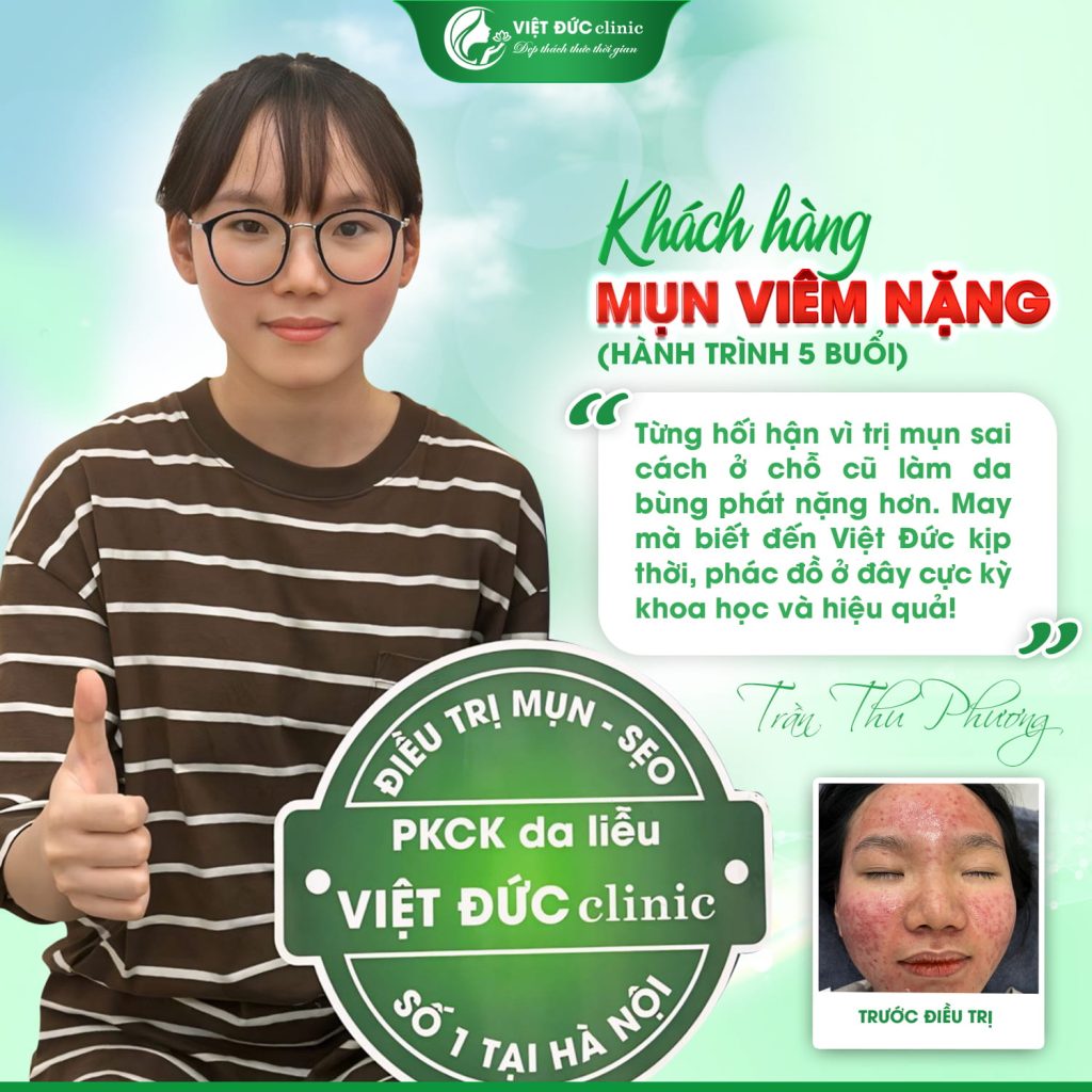 Bạn Thu Phương sau trị mụn da liễu Việt Đức chuẩn y khoa 