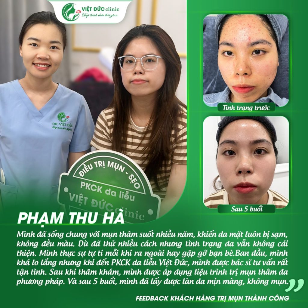 Khách hàng trị mụn da liễu Việt Đức chuẩn y khoa