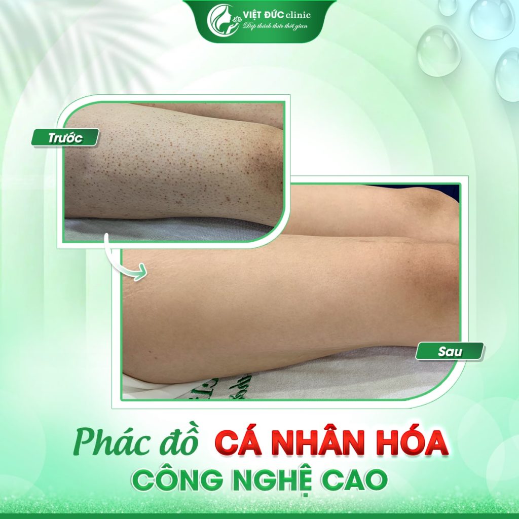 hieu-qua-chua-day-sung-nang-long-viet-duc-vung-chan-thuc-te