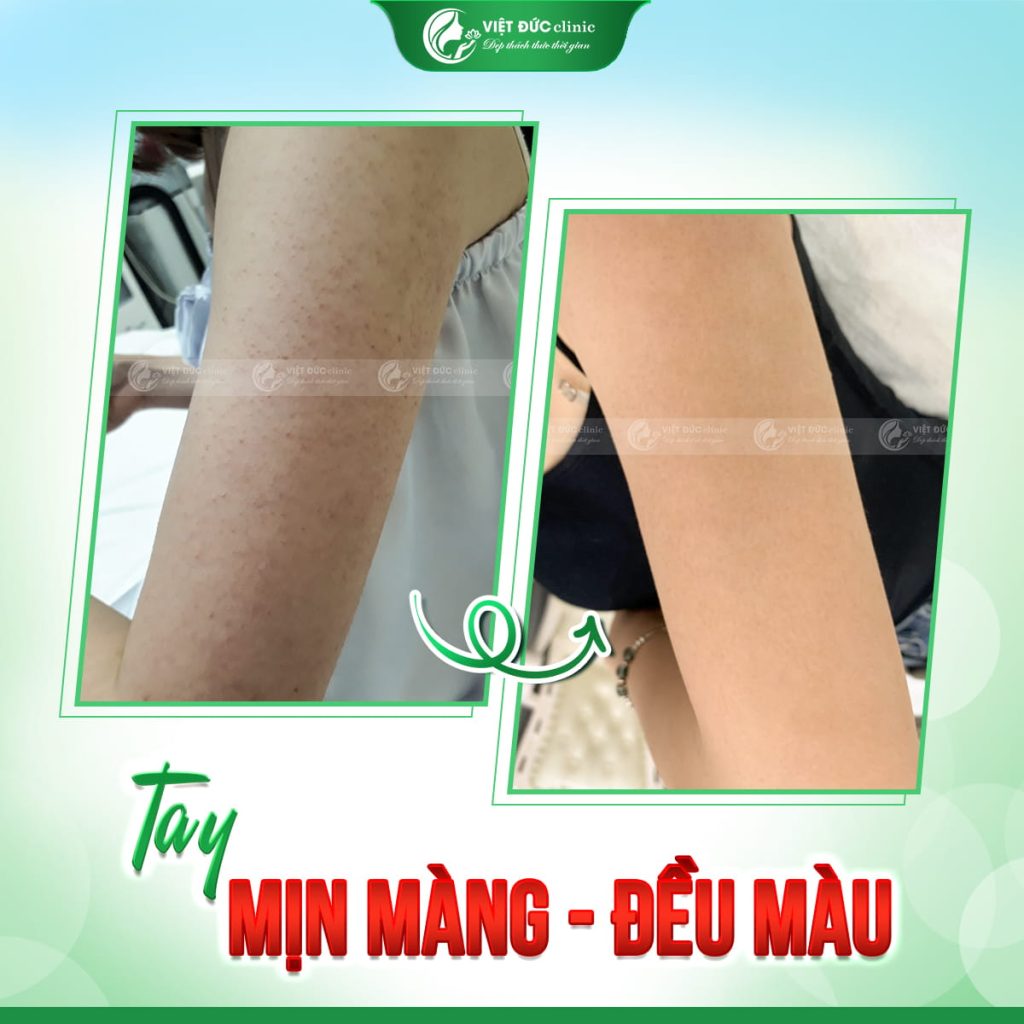 hieu-qua-dieu-tri-tu-bac-si-da-lieu-viet-duc 