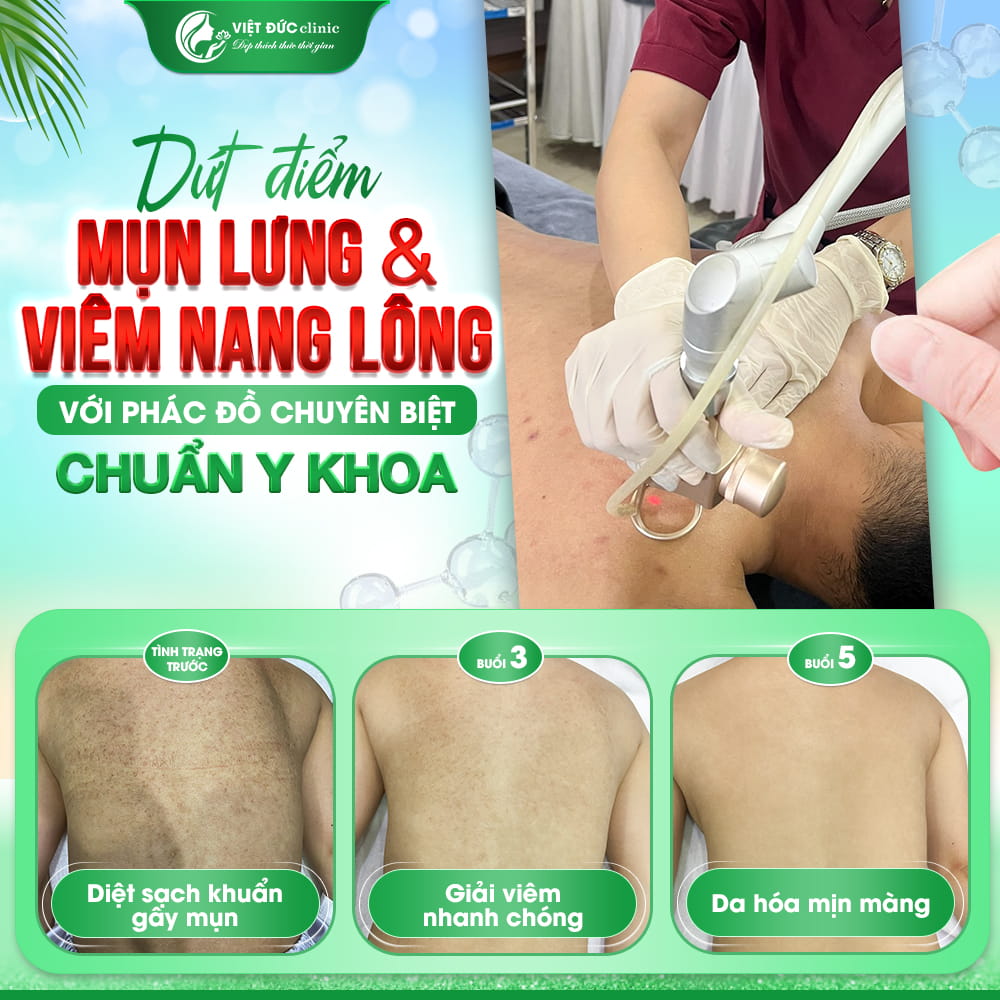 peel-tri-mun-lung-Viet-Duc-ket-hop-cong-nghe-cao