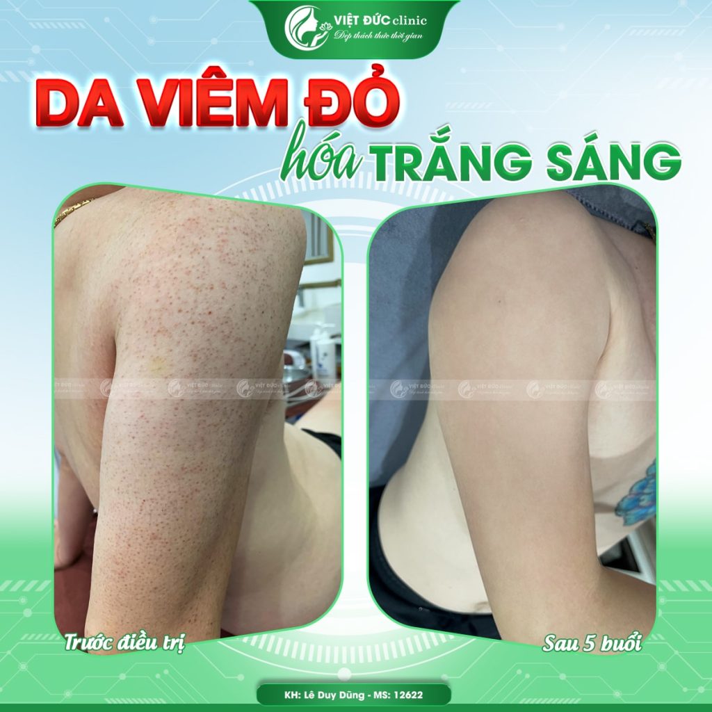 hieu-qua-chua-day-sung-nang-long-viet-duc-thuc-te