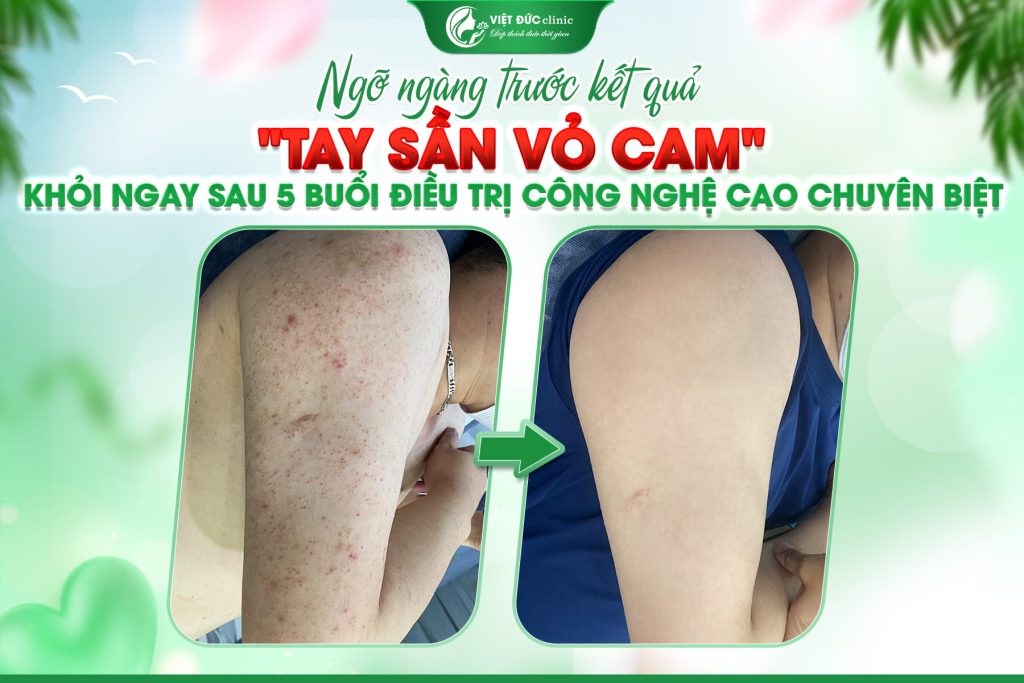 hieu-qua-sau-khi-chi-phi-tri-viem-nang-long-viet-duc
