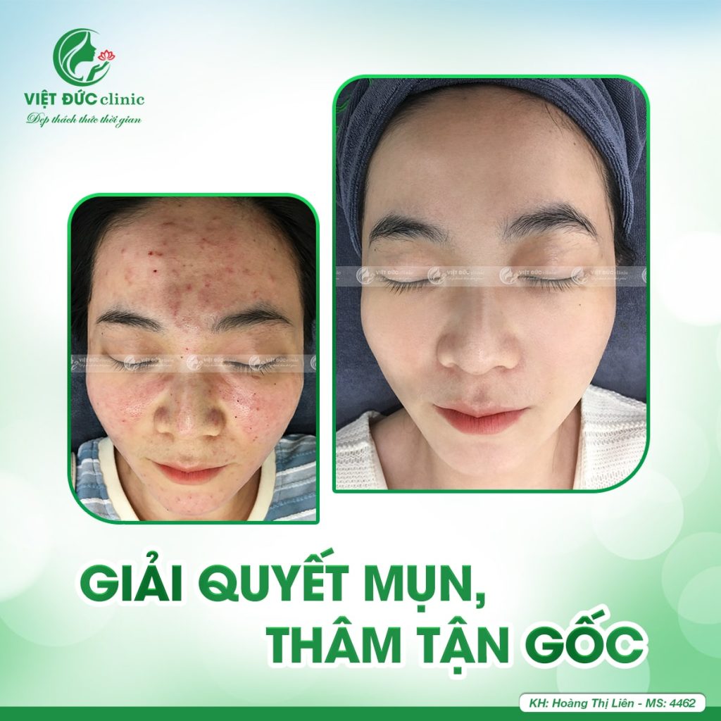 hieu-qua-cham-soc-da-sau-nan-mun-viet-duc