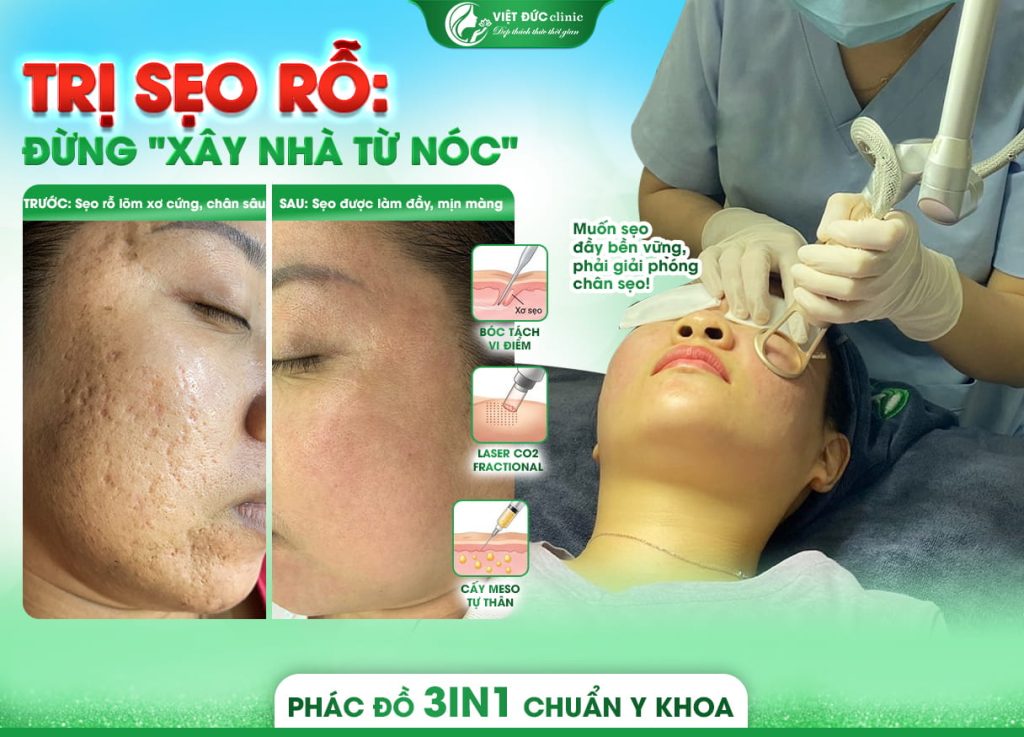 tri-seo-ro-da-lieu-viet-duc-bang-laser-co2-fractional