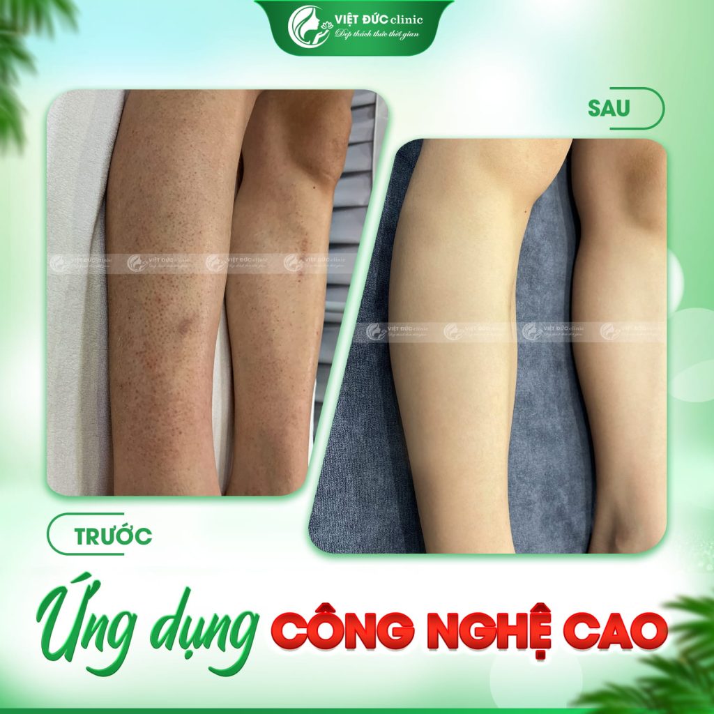 hieu-qua-triet-long-tri-viem-nang-long-viet-duc
