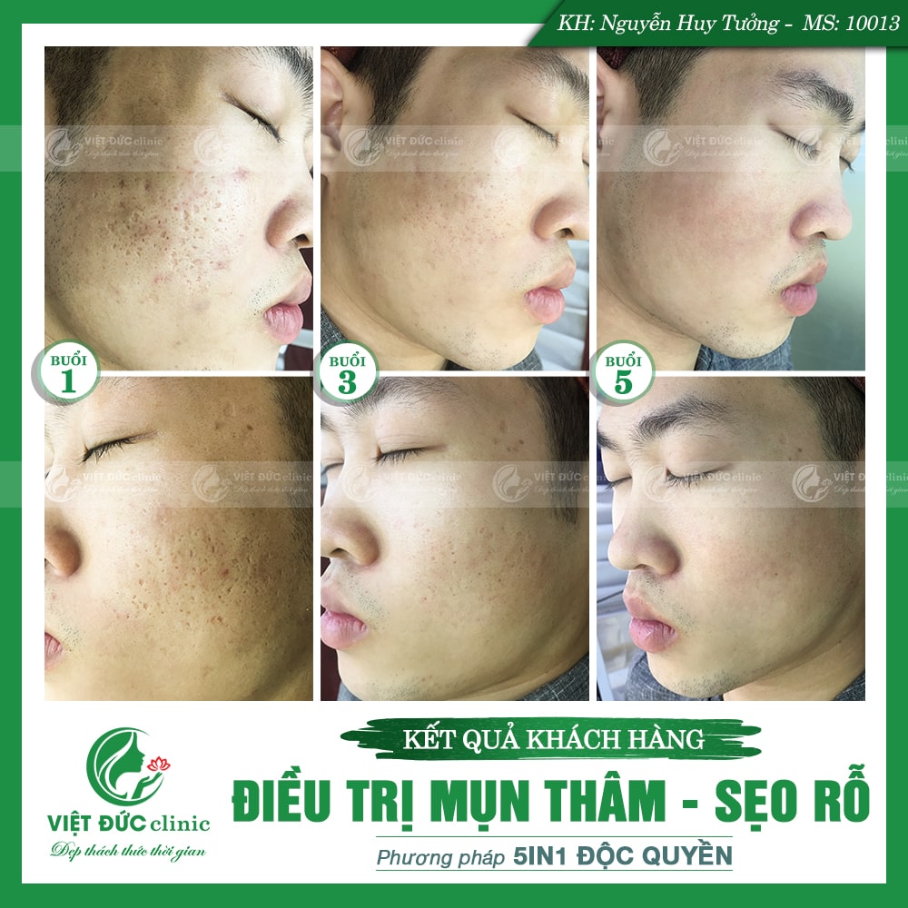 kinh-nghiem-kham-mun-da-lieu-viet-duc-thanh-cong