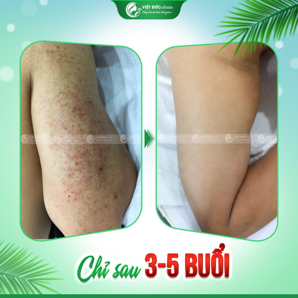 hieu-qua-peel-da-day-sung-nang-long-viet-duc