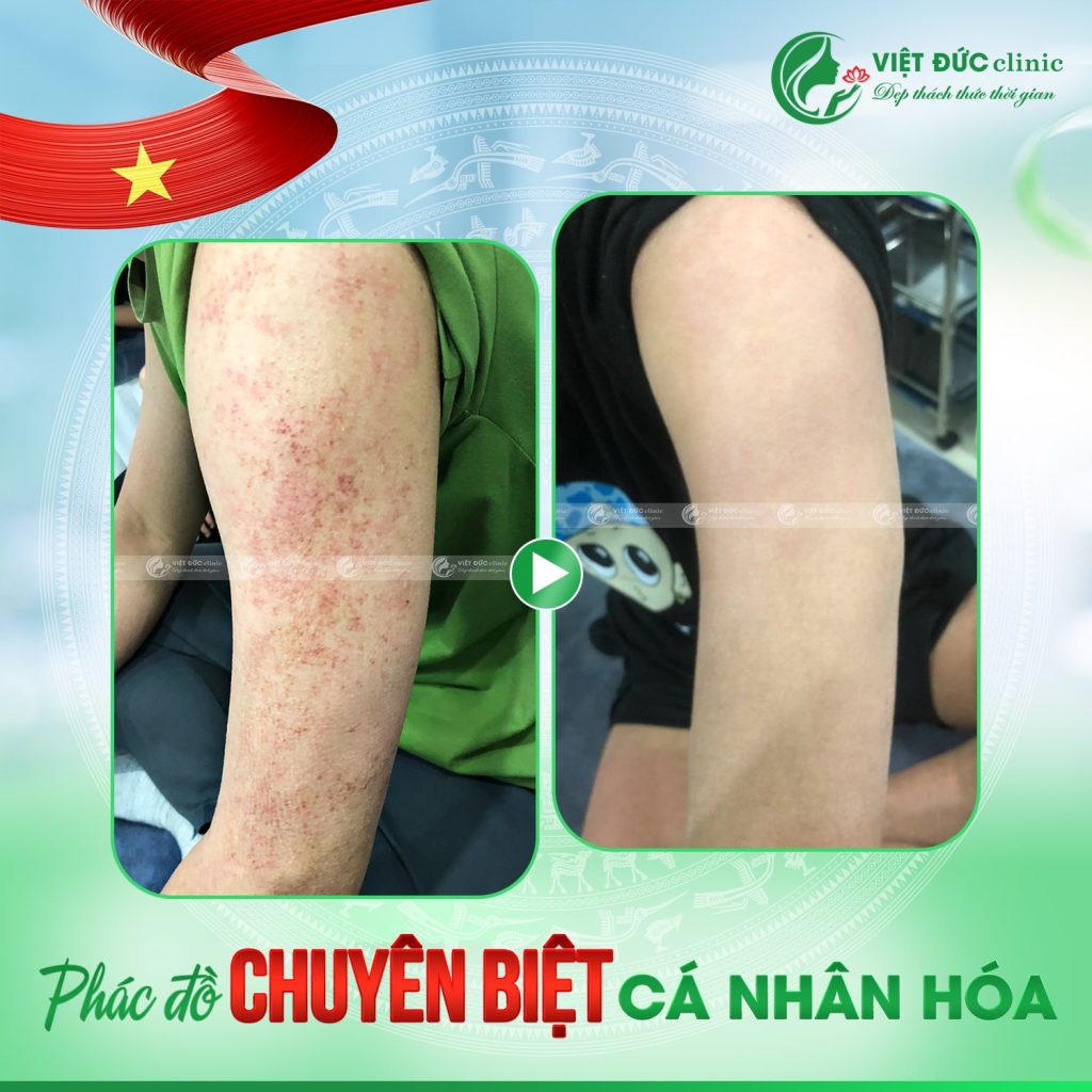 phac-do-phuc-hoi-da-day-sung-nang-long-viet-duc