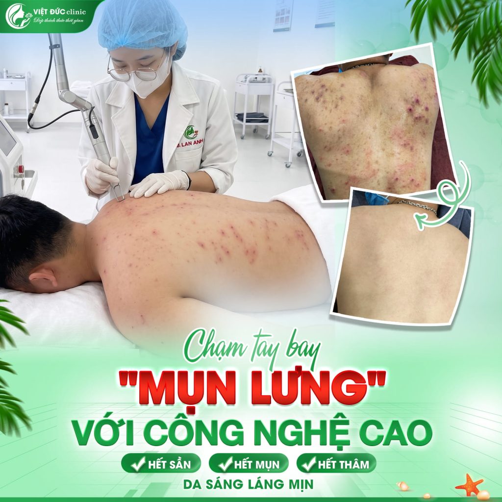 cong-nghe-hien-dai-tri-mun-lung-da-lieu-viet-duc